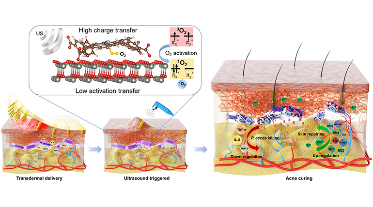 Microneedle Patch for Antibiotic-Free Acne Treatment