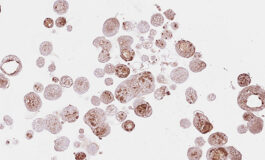 Cancer Organoids Offer Insights into Treatment Outcomes
