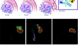 Targeted Radiotherapy Combined with Immunotherapy Kills 100% of Colorectal Cancer