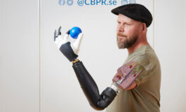 Above Elbow Amputee Controls Individual Bionic Fingers