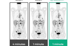 SubtlePET Artificial Intelligence Software Enhances PET Scans, Saves Time in Scanner