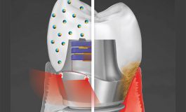Smart Dental Implant Resists Bacteria and Generates Electricity