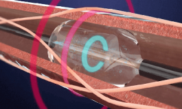 Ultrasound Catheter to Treat Hypertension